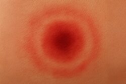 Informatie over erythema migrans