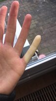 Raynaud bij pati?nt van Medi-Mere, huisarts Almere