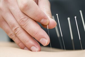 Dry Needling Therapie