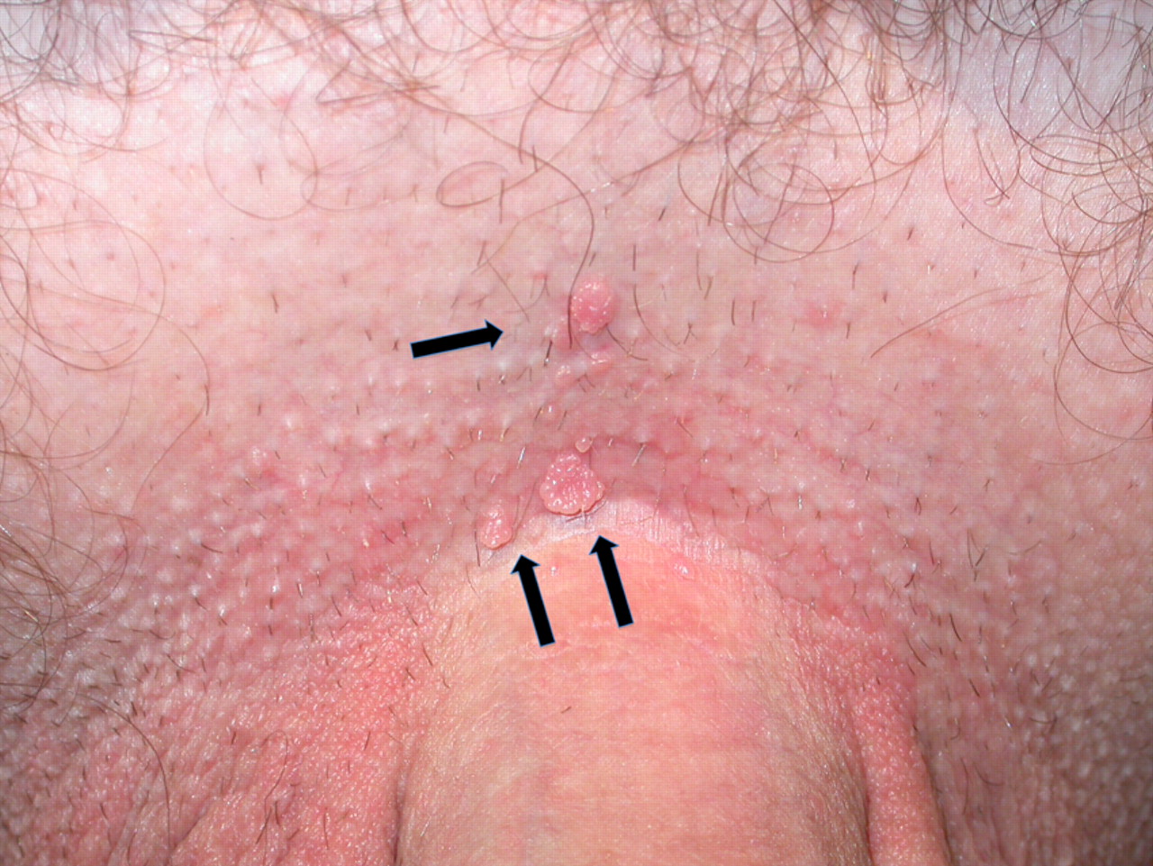 Hpv vírus torokrák. Az orális szex valóban torokrákot okozhat?